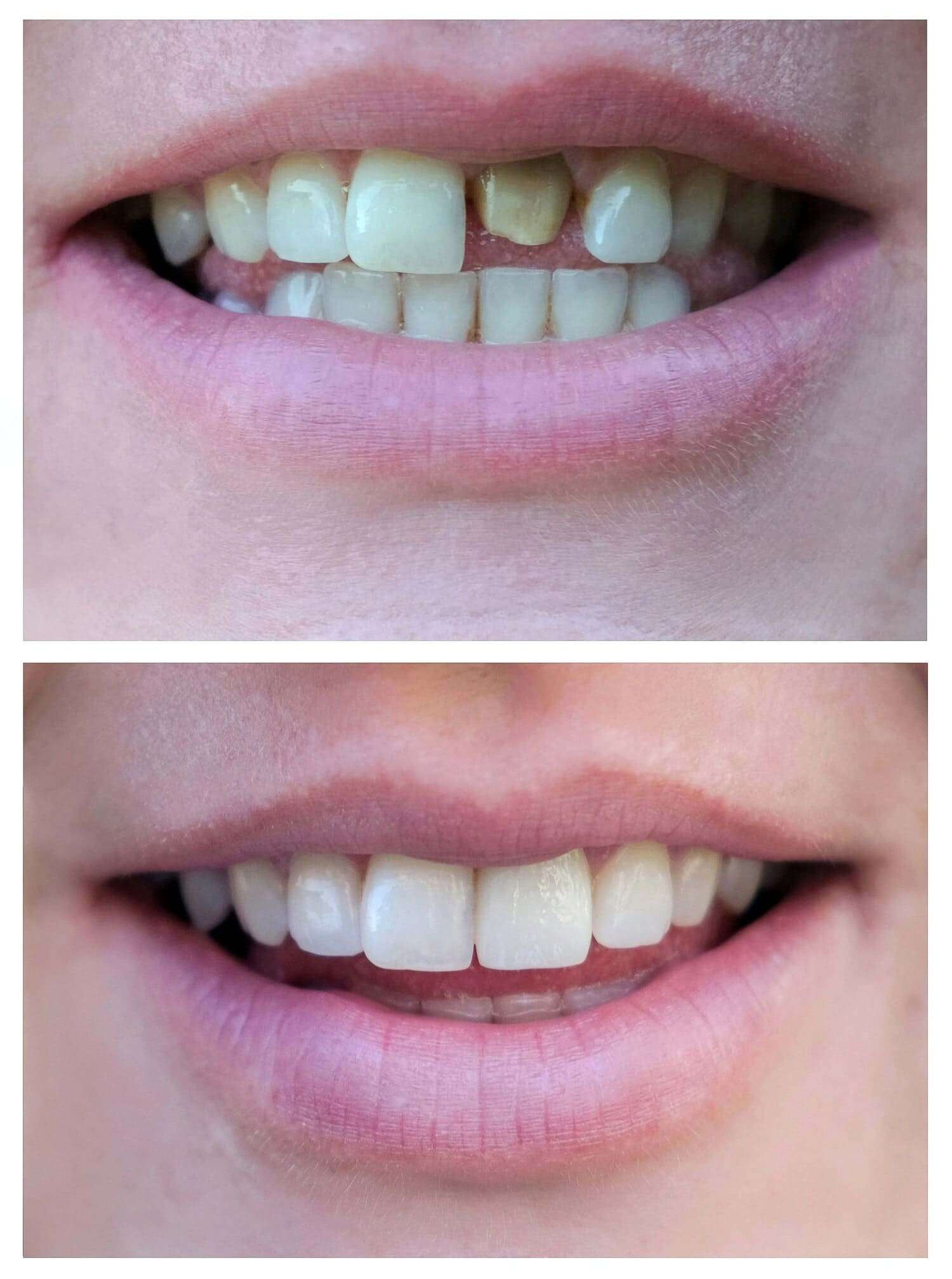 Chipped Tooth Repair​ Carrollton periodontist DFW texas before and after