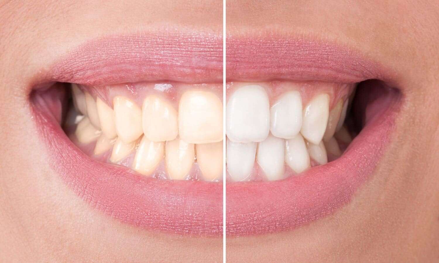 Teeth Whitening Transformative Patient Experience Dental Specialists
