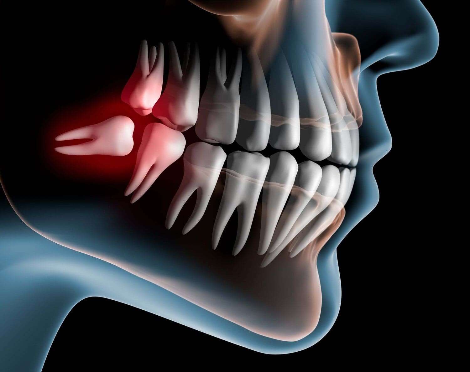 Wisdom Teeth Removal Dental Specialists at Carrollton Texas
