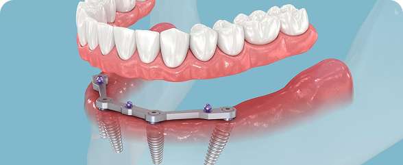 All-on-4 Dental Implants