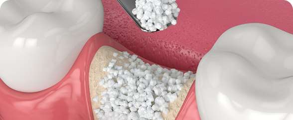 Bone GraftingAugmentation