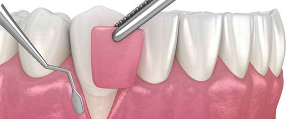 Crown Lengthening