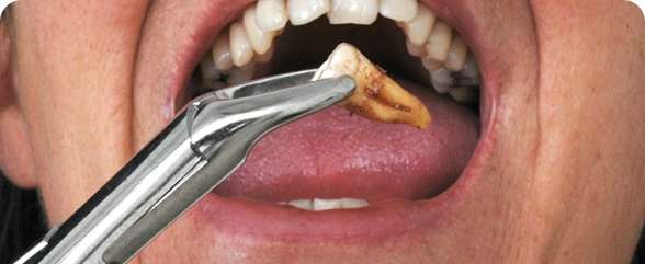 Emergency Tooth Extraction