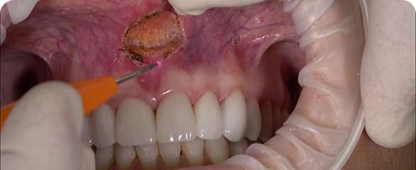 Frenectomy
