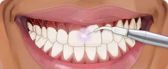 Aesthetic Dental Care 11 Gum Contouring