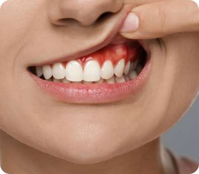 Gum Disease 1