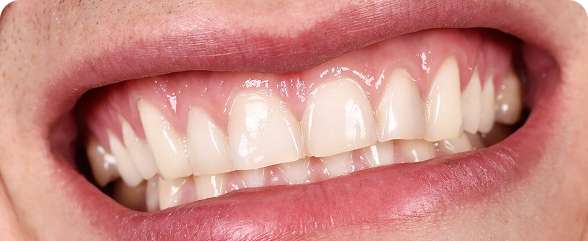 Gum Recession