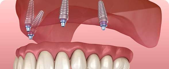 Implant Supported Dentures