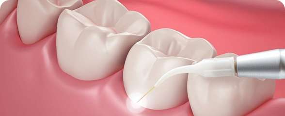 Aesthetic Dental Care 13 Laser Deep Cleaning