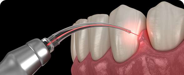 Aesthetic Dental Care 7 Laser Gum Surgery