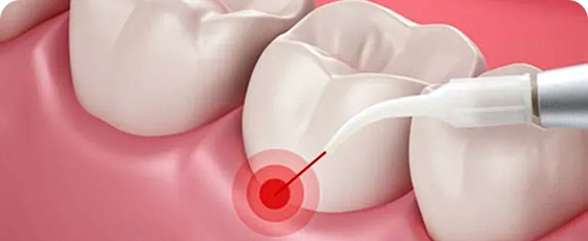 Aesthetic Dental Care 9 Laser Gum Therapy