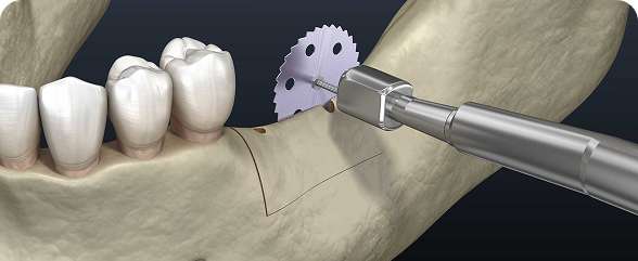 Ridge Augmentation