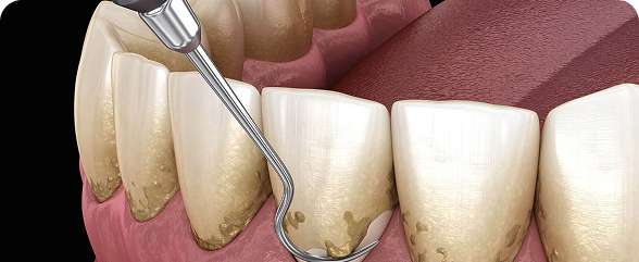 Aesthetic Dental Care 3 Scaling and Root Planing