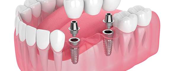 Single or Multi Dental Implant
