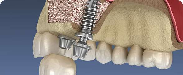 Sinus Lift Surgery