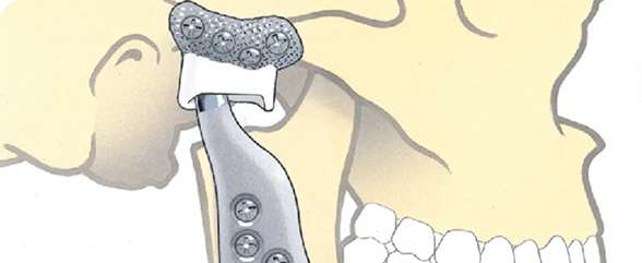 Temporomandibular Joint (TMJ) Surgery