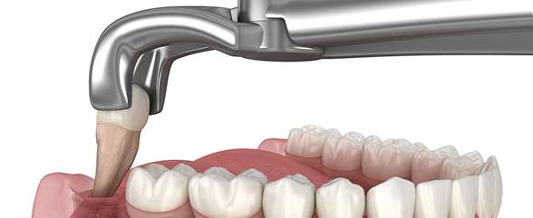 Wisdom tooth extraction