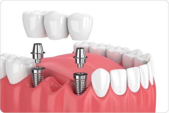 Implant Supported Dentures 9 Denture Consultation