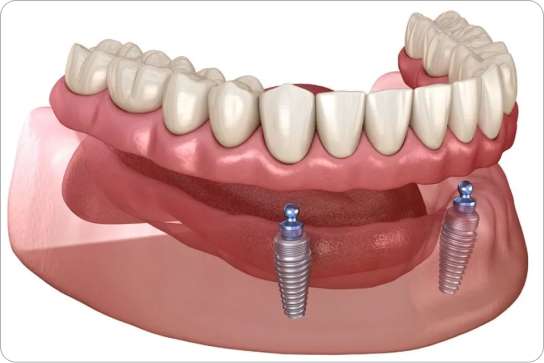 Implant Supported Dentures 1 Implant-Supported Dentures