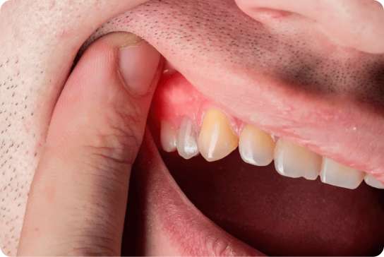 Gum Disease Treatment 1 Scaling and Root Planing Procedure 1
