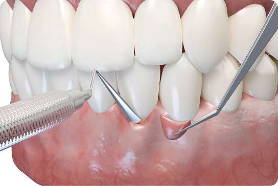 Scaling and Root Planing Procedure (4)