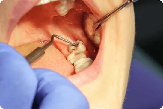 Wisdom Tooth Extraction 1 Scaling and Root Planing Procedure 5