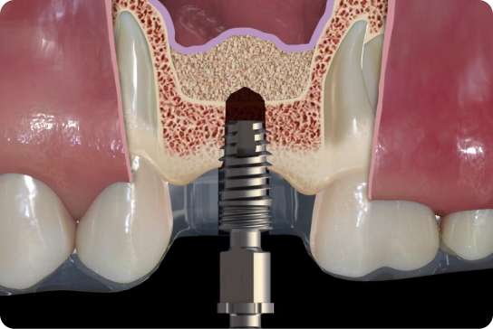 Scaling and Root Planing Procedure 6 1
