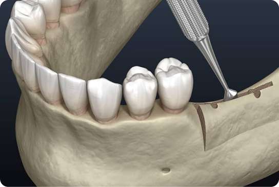 Ridge Augmentation 1 Scaling and Root Planing Procedure 7