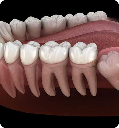 Wisdom Tooth Extraction 43 image 37