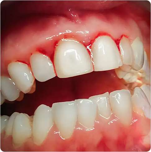 Gum Disease Treatment 13 image 42 (1)