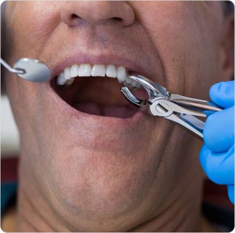 Emergency Tooth Extraction 3 image 42 11
