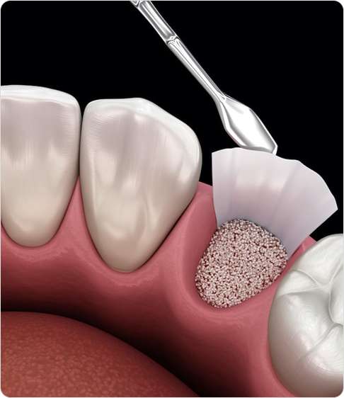 Bone Grafting 1 image 42 15