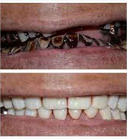 Full Mouth Restoration 1 image 42 17