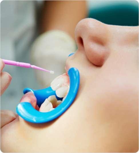 Preventive Dentistry 1 image 42 (19)