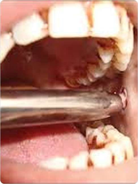Oral Biopsy 1 image 42 (23)