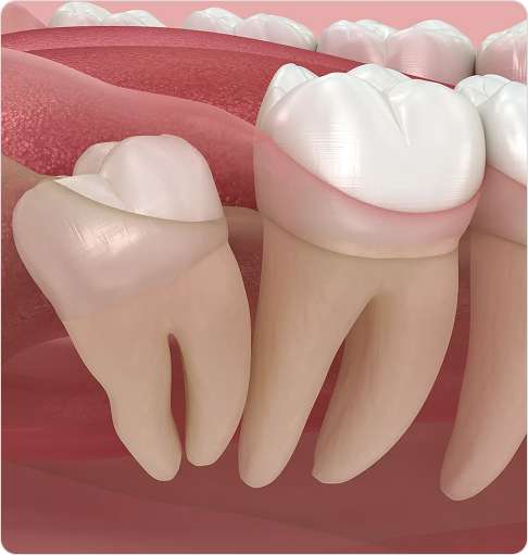 Wisdom Tooth Extraction 3 image 42 (6)