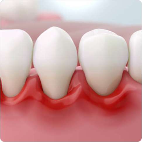 Gum Disease Treatment 3 image 42